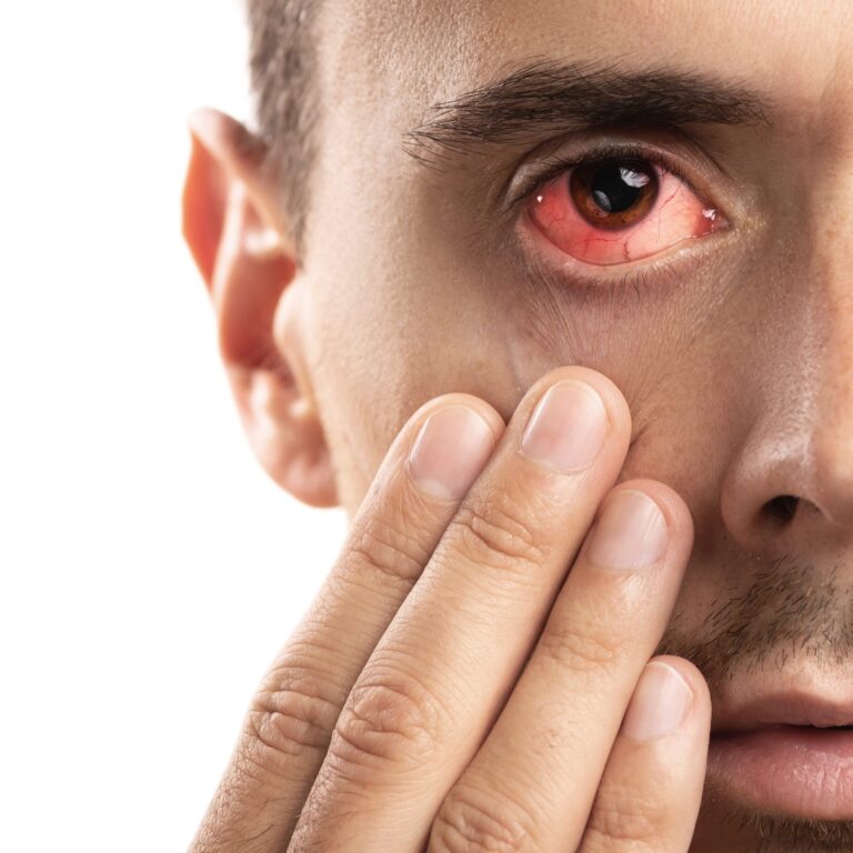 Why Does Sunscreen Burn My Eyes? How to Prevent Irritation in 6 Actions